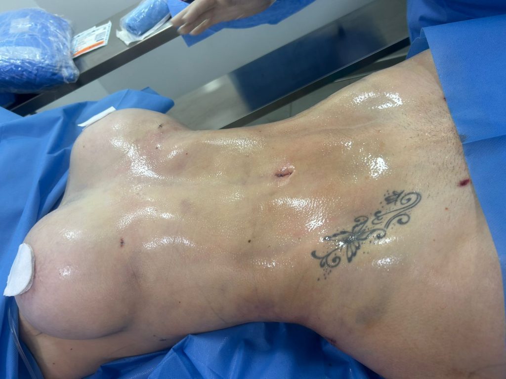 Mini liposucción en Santiago para grasa localizada