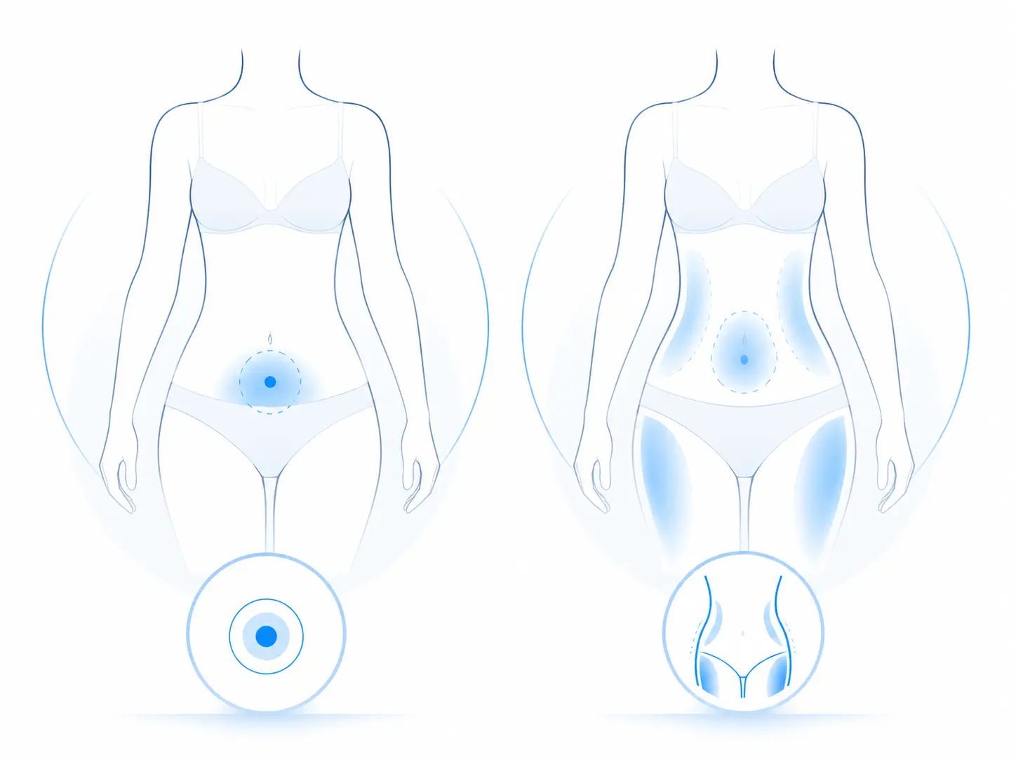 Diferencias entre mini liposucción y liposucción tradicional